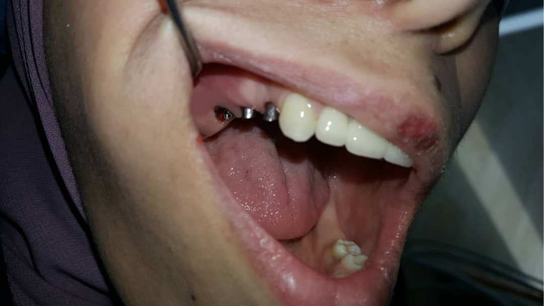 photo de cas dents manquantes avant implants dentaires algerie alger clinique dentaire ain taya