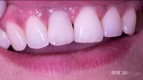 photo de cas apres implants dentaires algerie alger clinique dentaire ain taya