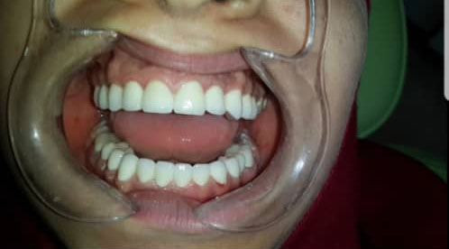 photo de cas dents jaunes carries apres traitement de soins dentaires algerie alger clinique dentaire ain taya