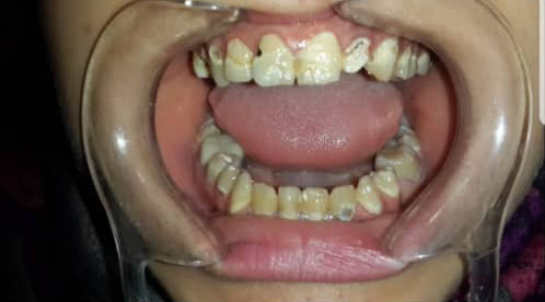 photo de cas dents jaunes carries avant traitement de soins dentaires algerie alger clinique dentaire ain taya