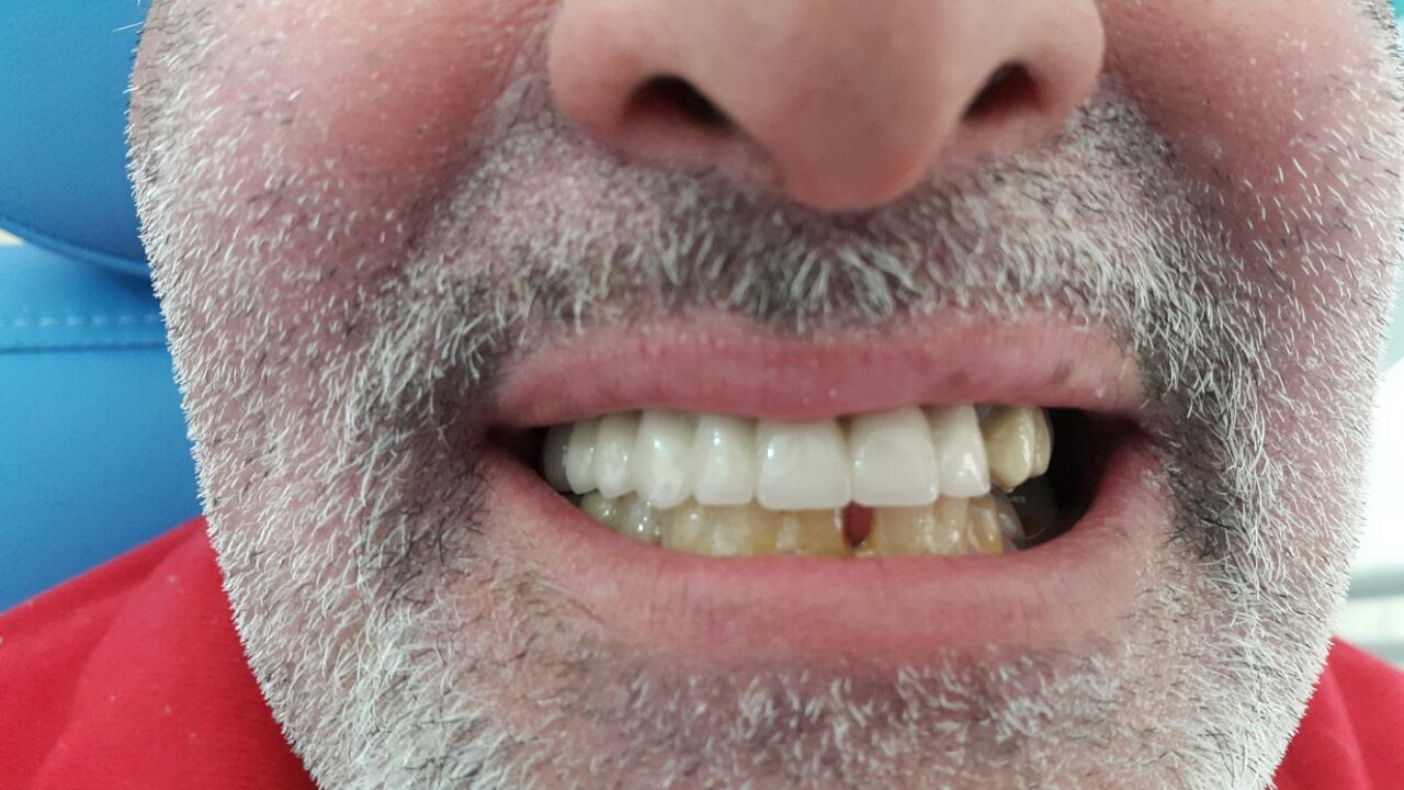 photo de cas apres implants dentaires algerie alger clinique dentaire ain taya