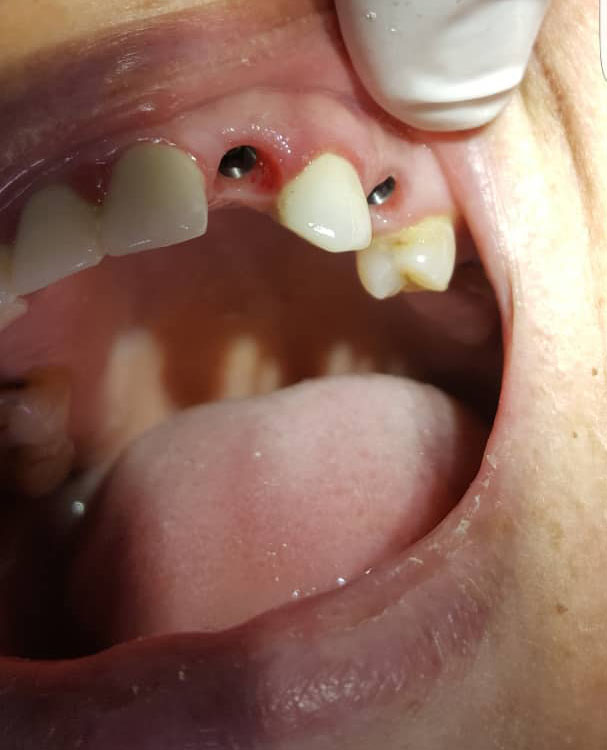 photo de cas dents manquantes avant implants dentaires algerie alger clinique dentaire ain taya
