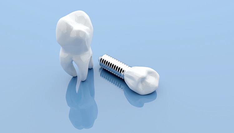 Remplacer une dent manquante tout savoir sur la pose d`implant dentaire