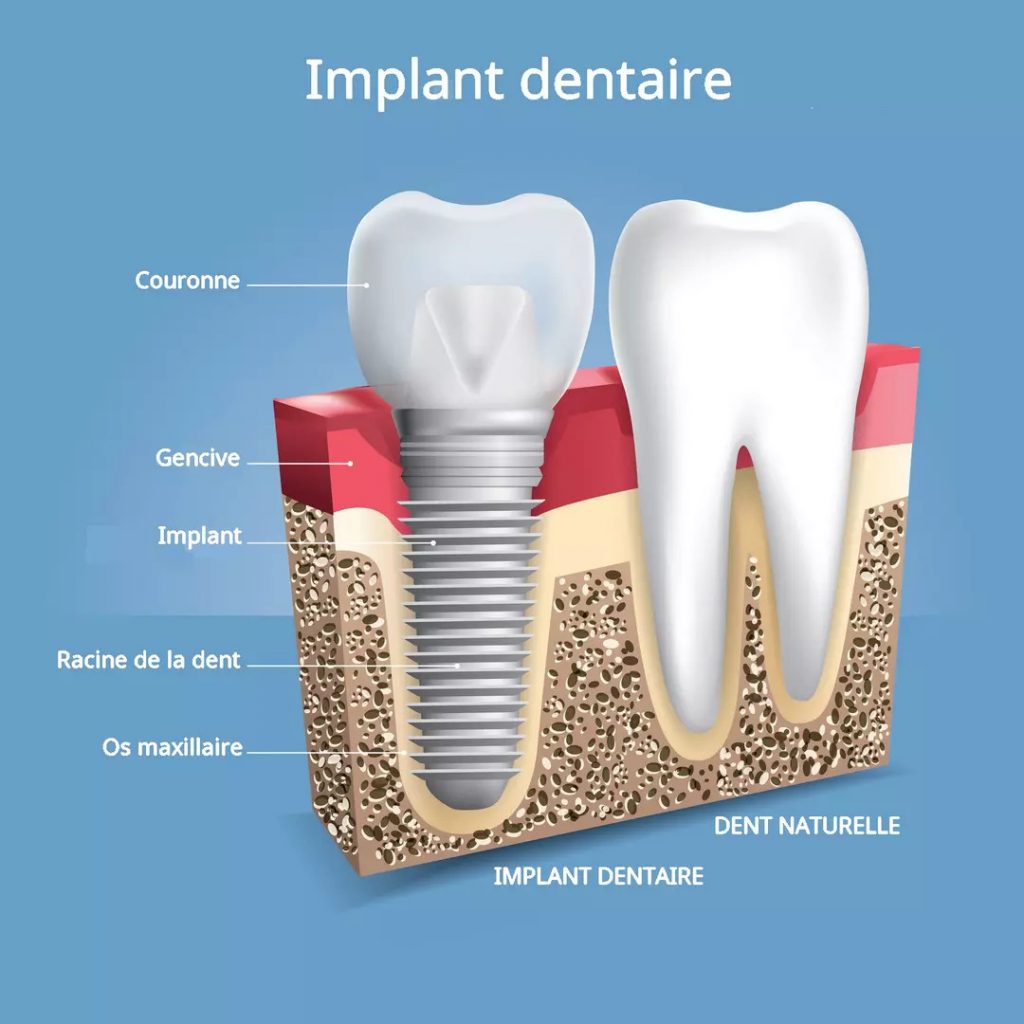 les composants d'un implant dentaire, couronne, racine, implant