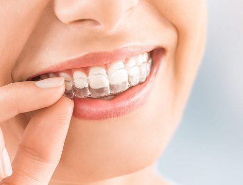 Gouttière dentaire transparente appareil dentaire transparente à Alger en Algerie